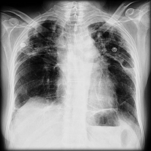 Dấu hiệu bệnh bụi phổi silic