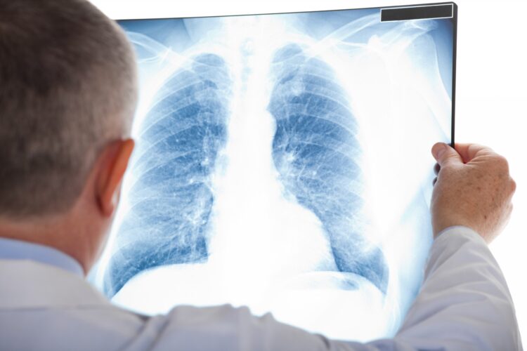 Chụp X-quang phổi